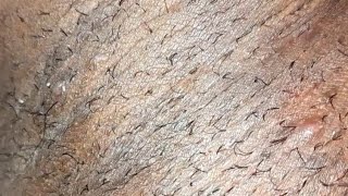 infected ingrown hair removal viral asmr ingrownhair trending hairremoval [upl. by Esinev]