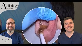 IRRIGATION OF HARD EAR WAX PLUG amp STUCK OTIP EXTRACTION EP832 [upl. by Yenaj]