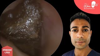 1322  Completely Sealed amp Impacted Ear Wax Removal [upl. by Gora]