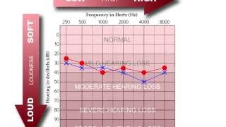 How to Read an Audiogram [upl. by Ahsirk]