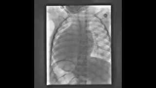 SITUS INVERSUS TOTALIS DEXTROCARDIA [upl. by Gastineau314]