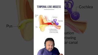 Mastoiditis for the USMLE  HyGuru [upl. by Leumel]