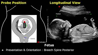 Obstetric Ultrasound Probe Positioning  Pregnant Uterus amp Fetus Transducer Placement USG Scan [upl. by Natsyrk]