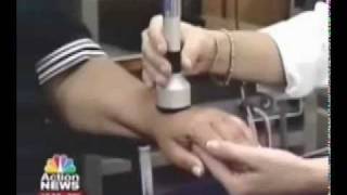 Alternative Carpal Tunnel Treatment National News report on Microlight ML830® Cold Laser Therapy [upl. by Alihet899]