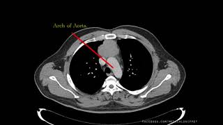 CT Thorax  How to Read [upl. by Anatollo352]