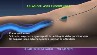 Animation of Ablación Laser Endovenosa [upl. by Atiuqaj]