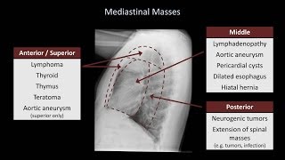 How to Interpret a Chest XRay Lesson 5  Cardiac Silhouette and Mediastinum [upl. by Tabber]