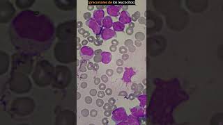 Así se ve la LEUCEMIA aguda al microscopio hematología leucemia laboratorioclinico [upl. by Eatnhoj424]