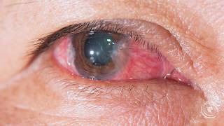 Dr Bigles talks about Pterygium [upl. by Helyn]