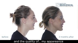 ALICJA Biretrusion  Bimaxillary Orthognatic Surgery with Surgery First Protocol [upl. by Hultin407]