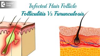 Infected hair follicle What to do Causes Location amp TreatmentDr Rasya Dixit  Doctors Circle [upl. by Gittel]