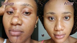 HOW TO GET RID OF HYPERPIGMENTATION ON THE FACEhyperpigmentation before and afterclearskin [upl. by Novelia666]