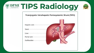 Transjugular Intrahepatic Portosystemic Shunt TIPS What Is TIPS Procedure amp TIPS Complications [upl. by Newberry]