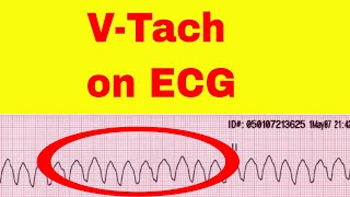 Non sustained Ventricular TachycardiaNSVTक्या हैWHAT IS NON SUSTAINED VTNSVT Is it DANGEROUS [upl. by Oicnevuj]