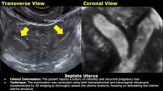 Congenital Uterine Anomalies Ultrasound Reporting  Didelphys Bicornuate Unicornuate Uterus USG [upl. by Selimah38]