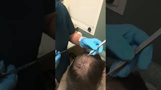 Watch the Stitches come out mybraintumorstory day20aftersurgery [upl. by Preuss]