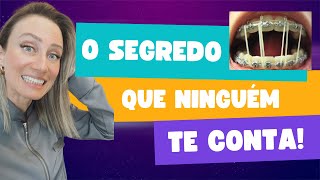 Elástico errado no aparelho 😰 aparelhoortodôntico Elástico intraoral [upl. by Nothgiel]