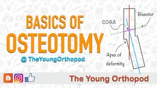 Basics of Osteotomy [upl. by Lia31]