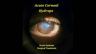 Acute Corneal Hydrops Surgical Draining [upl. by Haidabez]