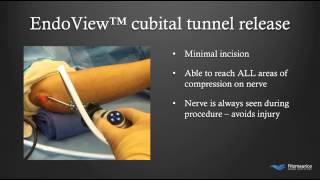 EndoTech® Endoscopic Cubital Tunnel Treatment  Fitzmaurice Hand Institute  Phoenix Arizona [upl. by Mercado693]