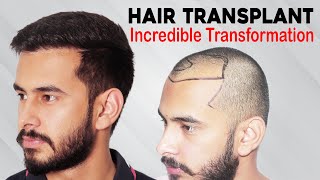 Best Hair Transplant in India Cost  Best Clinic  Medispa Hair Transplant in India  Dr Suneet Soni [upl. by Karilla]