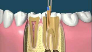 Leczenie kanałowe [upl. by Ardnahs]