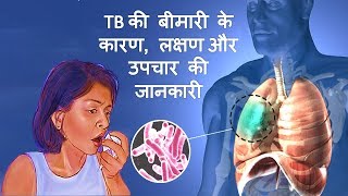 Tuberculosis TB के कारण लक्षण और उपचार – Tuberculosis Causes Symptoms amp Treatment in Hindi [upl. by Walley]