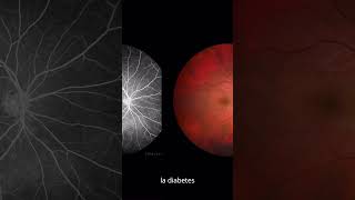 ¿Qué causa la retinopatía diabética salud diabetesmellitustipo2 prevencióndeenfermedades [upl. by Anevad]