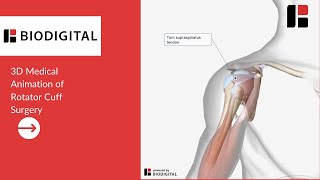 3D Medical Animation of a Rotator Cuff Surgery [upl. by Hollis]