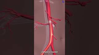 How Brain Clot Is Removed 3D Animation Mechanical Thrombectomy For Acute Ischemic Stroke [upl. by Anisamoht]