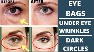 🛑 ANTIAGING FACE EXERCISES FOR EYE BAGS DARK CIRCLES EYE WRINKLES PUFFY EYELIDS DROOPY EYELIDS [upl. by Locke425]