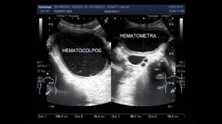 Ultrasound Video showing Hematocolpos with hematometra or Hemometra [upl. by Macfadyn]