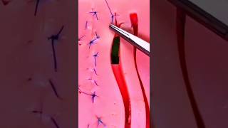 Surgical stitchesSuturing techniquesआइए एक साथ टांके लगाएंviralshortsshortsfeedsdrsadia1446 [upl. by Loy]