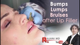 Bumps Lumps Swelling and Bruising after lip FillersDr Rajani [upl. by Oreste]