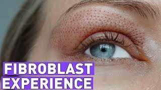 Fibroblast Treatment  Before amp After vídeo diary [upl. by Yrem758]