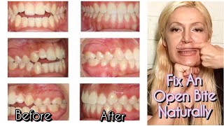 How To Fix An Open Bite Naturally No Braces No Surgery [upl. by Airamak656]