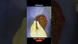 Gallbladder stones  Gallbladder dissection  laparoscopic cholecystectomy [upl. by Terrie]