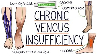 Understanding Chronic Venous Insufficiency [upl. by Agnot556]