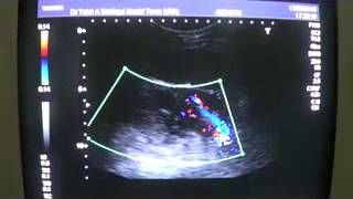 BOSNIAK RENAL CYST TYPE 11 [upl. by Akibma]