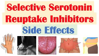 SSRI Antidepressant Side Effects amp Why They Occur  Fluoxetine Paroxetine Sertraline Citalopram [upl. by Denoting]