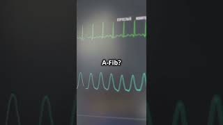 NEVER Miss These AFiB Signs on an ECG [upl. by Kralc]