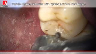 Caries Removal amp Cavity Preperation with Fotona Lightwalker ErYAG Laser [upl. by Solahcin]