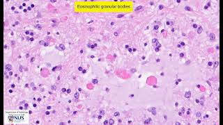 Pilocytic astrocytoma microscopy  Talking slide [upl. by Nnylassej]