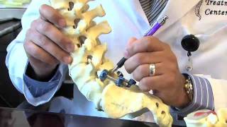 Surgical Procedures  Lumbar Laminectomy amp Discectomy [upl. by Ailemac]