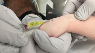 IV Insertion Technique in Infants and Small Children [upl. by Anig]