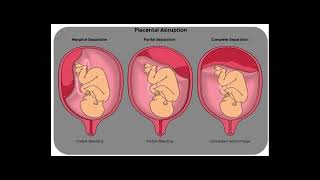 PLACENTAL ABRUPTION [upl. by Yelyr352]