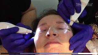 Plexr Treatment Review  Tracey Bell  Before and After [upl. by Asilaj543]