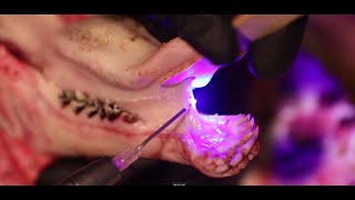 Tongue Tie Procedure Frenectomy using S1 PIOON 450 wavelength laser [upl. by Bourgeois577]