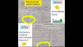 Satisfactory OVULATION STUDY results post Ayurvedic treatment [upl. by Zashin]