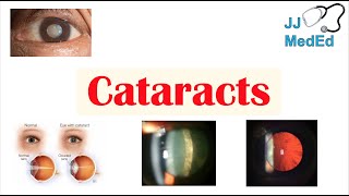 Cataracts  Causes Risk factors Subtypes Cortical Nuclear Posterior subcapsular Treatment [upl. by Eehc]